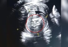 Bebê nasce com dois fetos dentro do abdômen em caso raro da medicina