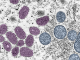 Brasil registra primeiro caso de mpox pela cepa 1b em paciente de São Paulo