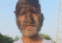 Adolescente indiano entra para o Guinness por quebrar recorde de rosto mais peludo