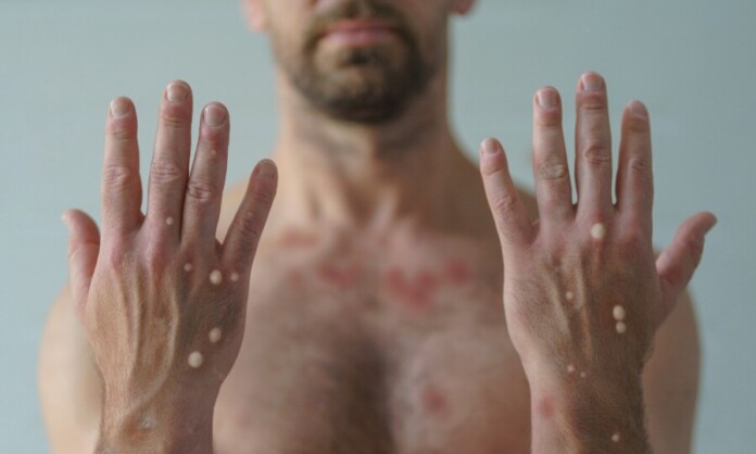 a006d1fb8e68_1000x600-monkeypox-homem-mãos