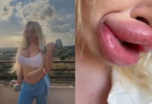 Influencer não consegue fechar a boca após inúmeros preenchimentos labiais