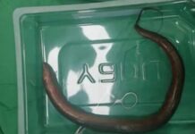 Médicos encontram enguia viva ‘nadando’ no abdômen de paciente chinês