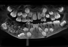 Menino de 7 anos passa por cirurgia e tem 526 dentes retirados