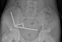 Adolescente passa por cirurgia após engolir dezenas de ímãs de alta potência