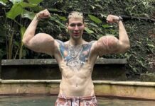 Influencer russo chamado de “Popeye” pode ter braços amputados após uso de substância perigosa